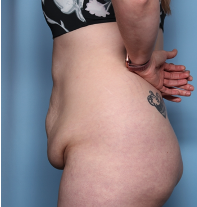 Body Lift Before & After Patient #34335